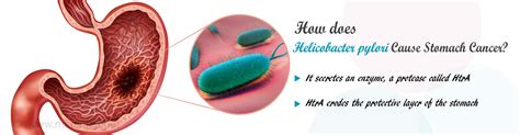 How Do Helicobacter Pylori Bacteria Cause Stomach Cancer