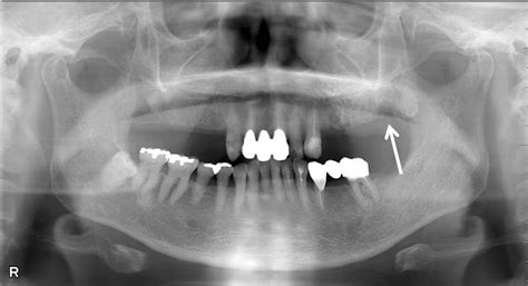 Dental Panoramic Radiograph After Extraction Of 2nd M Focus Of