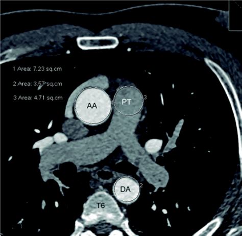 Thoracic Aorta Anatomy