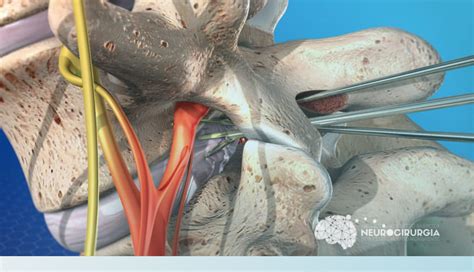 Como Feita A Cirurgia De Laminectomia Dr Victor Barboza