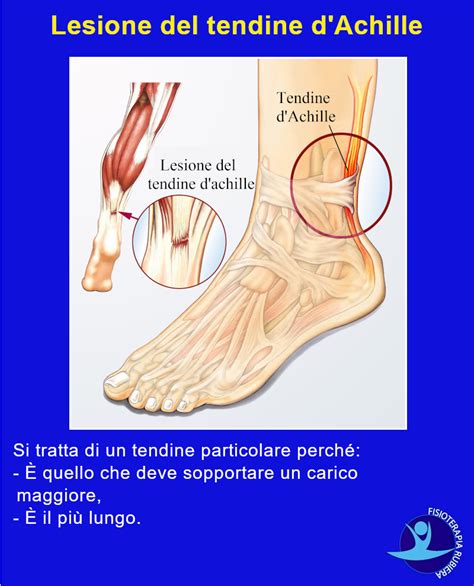 Inattivo Recur Esercito Dolore Tendine Piede Vena Saggio Per