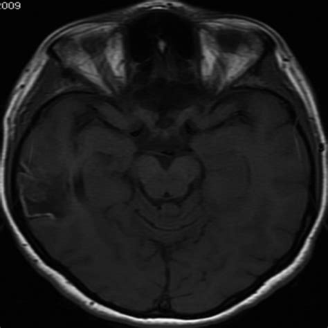 Cortical Laminar Necrosis Axial T1 Weighted Image Transverse Section