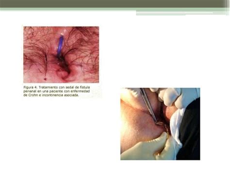 Abscesos y fístulas ano rectales PPT