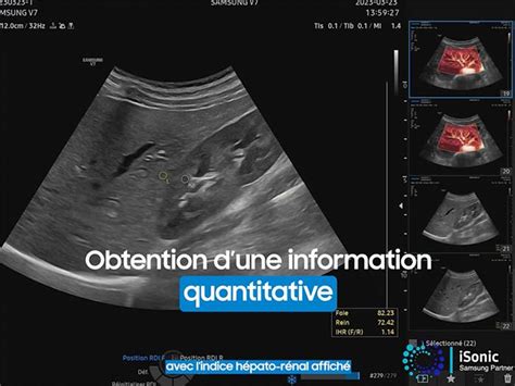 Échographes Samsung EZ HRI pour la stéatose hépatique
