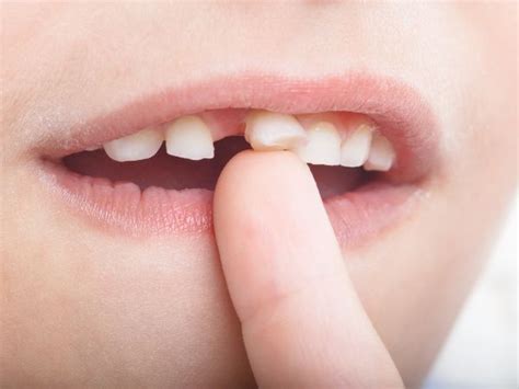 Dentes De Leite Esperar Cair Ou Arrancar Entenda Aqui Agenda Consulta