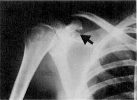 Figure 3 From Fractured Coracoid Process In Acromioclavicular Dislocations Semantic Scholar