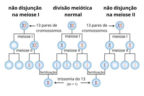 O Que é A Síndrome De Patau Trissomia 13 Causas E Sintomas