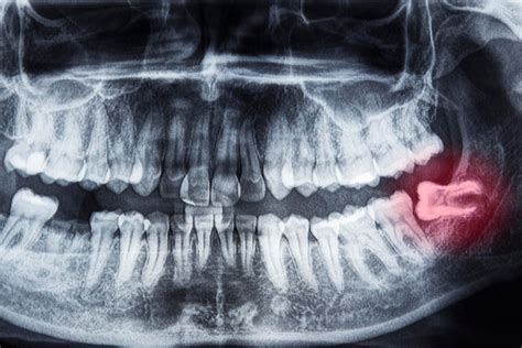 Denti Inclusi Inclusione Dentale