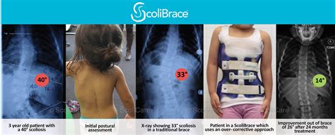 Az Scoliosis Treatment No Surgery Bracing 480 892 0022