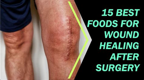 Best Foods For Wound Healing After Surgery Youtube