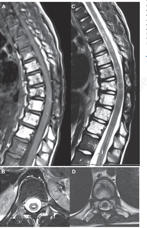 Figure 2 From Radiation Induced Spinal Cord Hemorrhage Hematomyelia