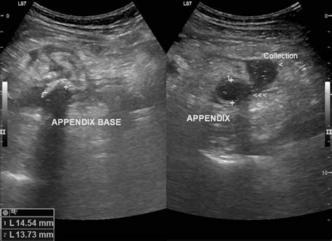 Radiopaedia Appendicitis It May Be Acute Or Chronic