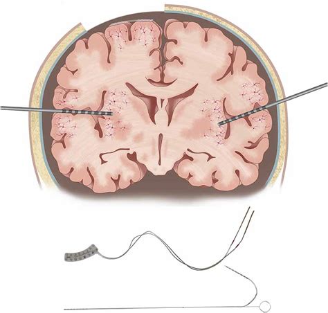 Frontiers Electrical Stimulation Mapping Of Brain Function A Comparison Of Subdural