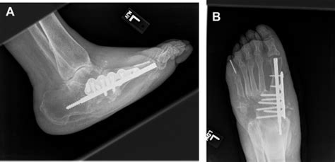 Charcot Neuroarthropathy Advances Clinics In Podiatric Medicine And