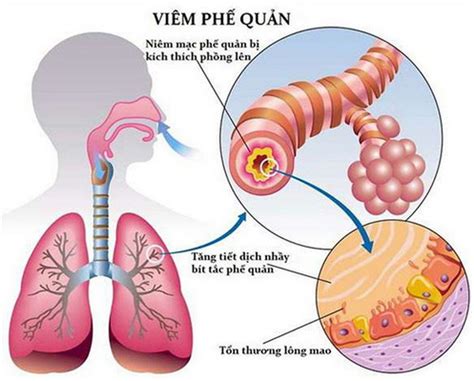 Phân biệt viêm phế quản do virus và vi khuẩn