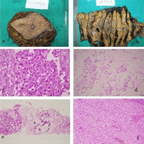 A F A Gross Photograph Of Breast Carcinoma B Left Mrm Serially