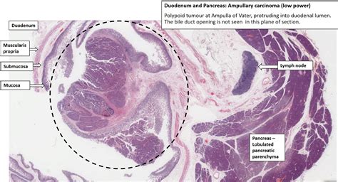 Duodenum And Pancreas Ampullary Carcinoma Nus Pathweb Nus Pathweb