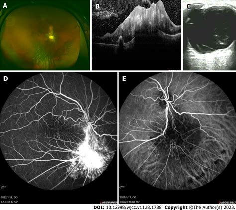 Combined Hamartoma Of The Retina And Retinal Pigment Epithelium A Case