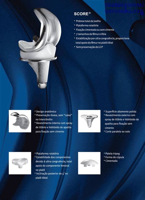 Componentes Da Prótese Total De Joelho Ou Implantes Traumatologia E