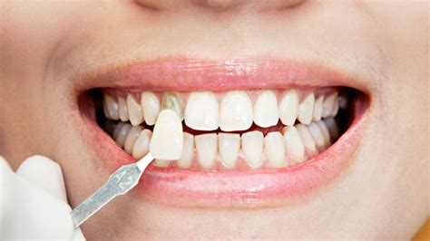 Carillas Sin Tallado Cuales Son Y Como Se Colocan Clinica Dental Palomero