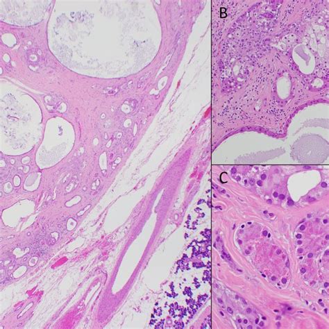 Sclerosing Polycystic Adenoma Of Patient 1 A Well Circumscribed Tumor