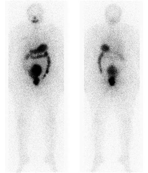 Post Therapeutic Whole Body Scanning Showing A Mild Uptake In The Neck