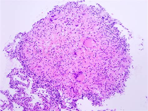 What goes on inside a caseating granuloma? | Pathology Student