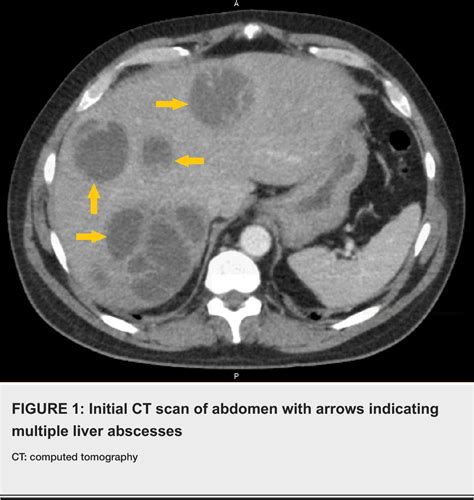 Figure 1 From Liver Abscesses Caused By Streptococcus Intermedius In An Immunocompromised