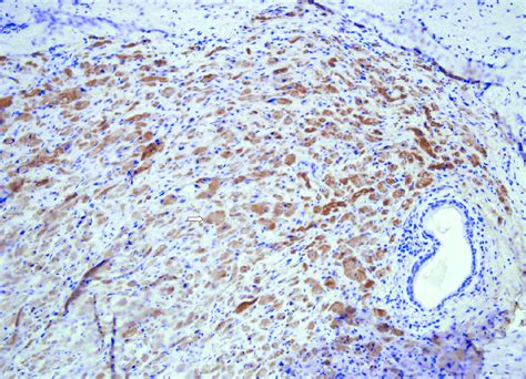 B Hematoxylin And Eosin Staining Combined With Immunohistochemical