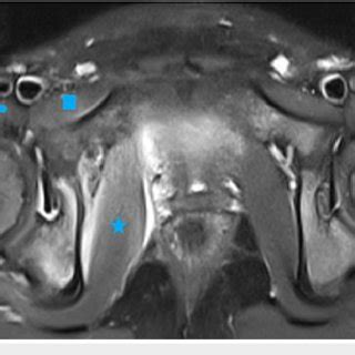 a) Right hip ultrasound indicating the presence of joint effusion (2.4... | Download Scientific ...