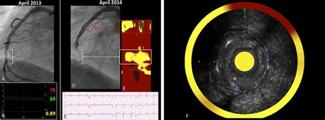 Combined Near Infrared Spectroscopy And Intravascular Ultrasound