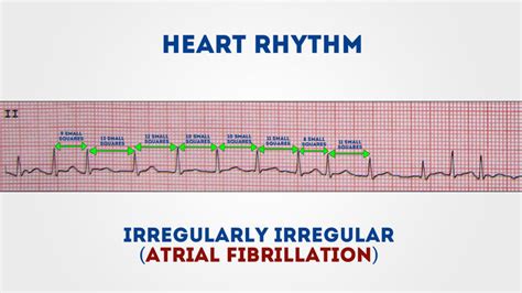 Cara Membaca Ekg Saat Mengecek Kondisi Jantung Perhatikan Setiap