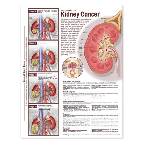 Buy Understanding Kidney Cancer Anatomical Chart Book Online At Low