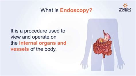 Endoscopy Types Preparation Diagnosis Procedure And Risks PPT