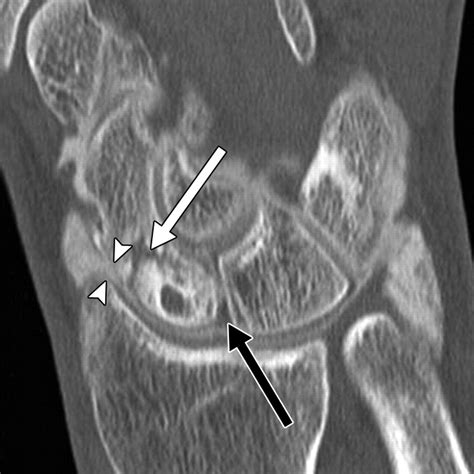 Scapholunate Advanced Collapse And Scaphoid Nonunion Advanced Collapse