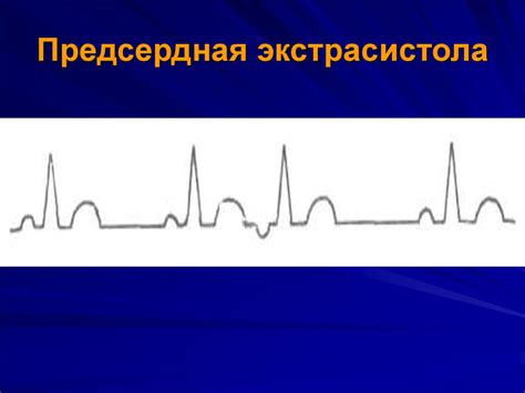 Определение экстрасистолии - презентация онлайн