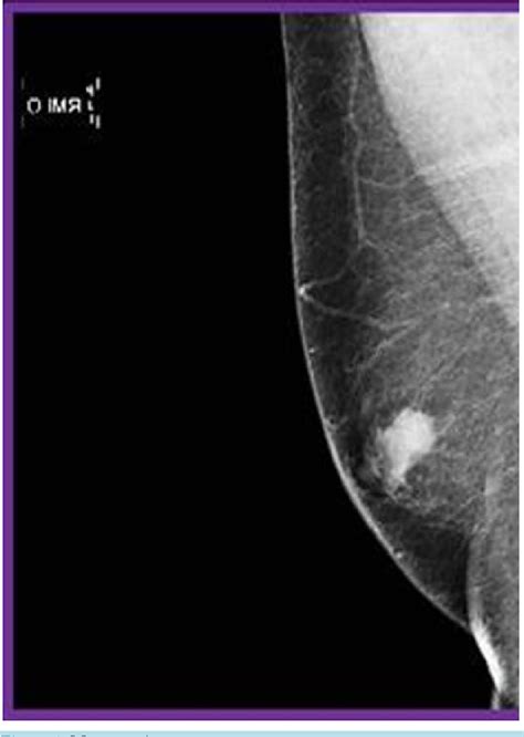 Figure 1 From A Case Report Of Calcifying Epithelioma Of Malherbe