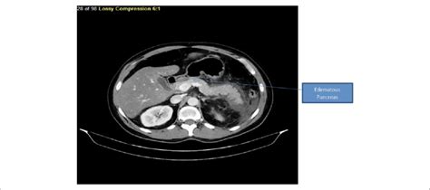 Section Of Computed Tomography Scan Showing Diffuse Parenchymal Download Scientific Diagram