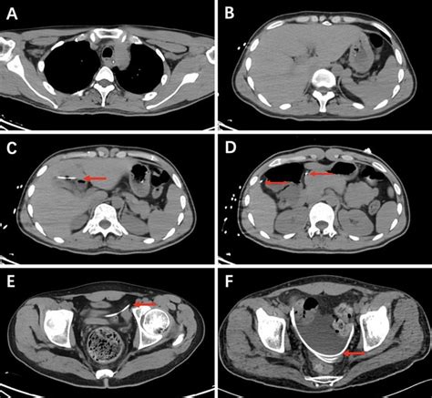 Frontiers Case Report Ventriculoperitoneal Shunt Disconnection