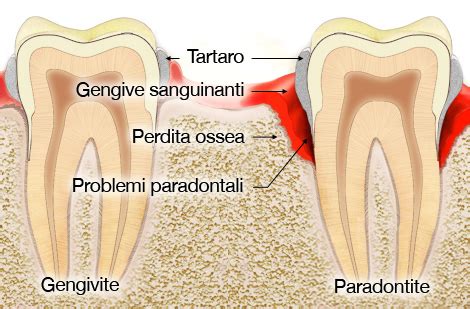 Parodontite Prevenzione E Cura Specialisti Parodontite Sintomi