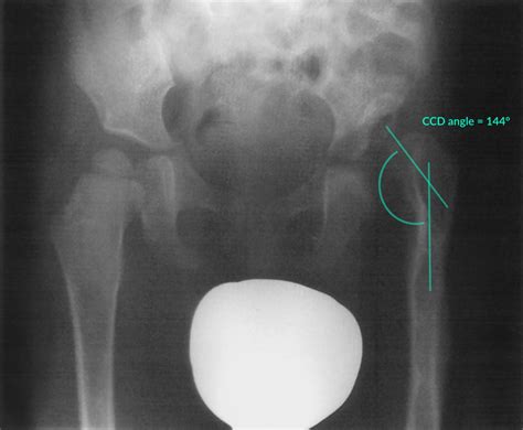 Congenital Hip Dysplasia Xray