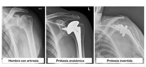 Prótesis invertida de hombro Qué es y para qué sirve Traumatopedia