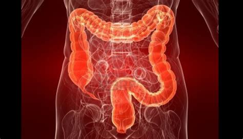 Experts Remind The Importance Of Early Detection Of Colon Cancer