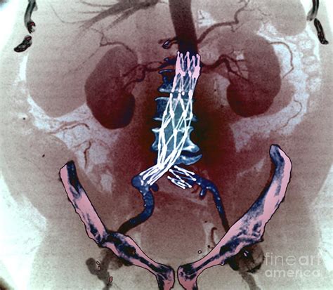 Aortic Aneurysm Stent Photograph By Zephyrscience Photo Library Fine Art America