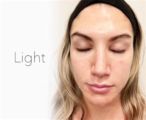 Light Chemical Peels The Skin Clinics