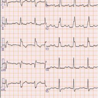 Electrocardiogram Showing Sinus Rhythm First Degree Atrioventricular