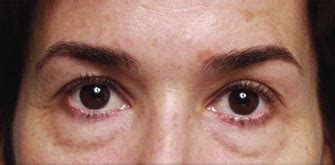 Dark Circles Surgery Beverly Hills | How To Get Rid of Eye Bags