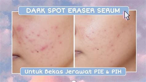 Rekomendasi Skincare Menghilangkan Bekas Jerawat 2 Minggu Skintific Symwhite 377 Dark Spot