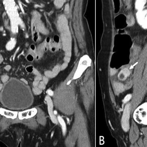 Contrast Enhanced Coronal And Sagittal Computed Tomography Scans A