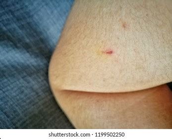 Skin Disease Lesion Ecchymosis Vasculitis Stock Photo